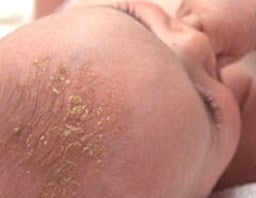 How to treat Cradle Cap